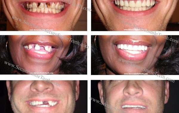 fake-white-teeth