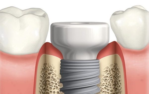 healing-abutment
