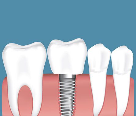 implant-dentistry