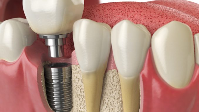 implant-teeth