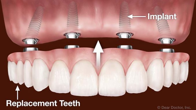 inexpensive-dental-implants