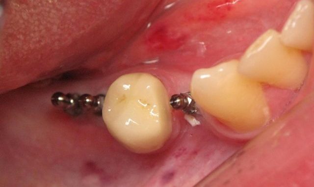 mini-implants-near-me