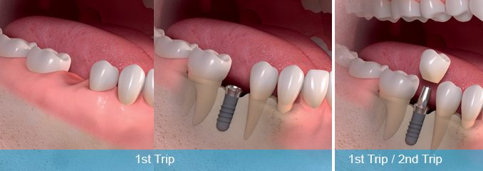 one-day-dental-implants