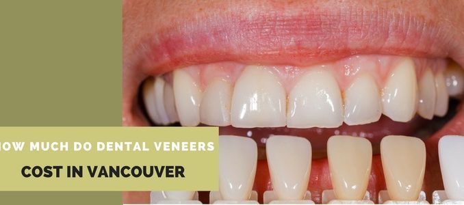 teeth-capping-prices