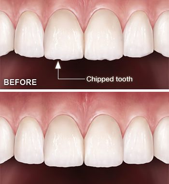 teeth-shaping-after-braces