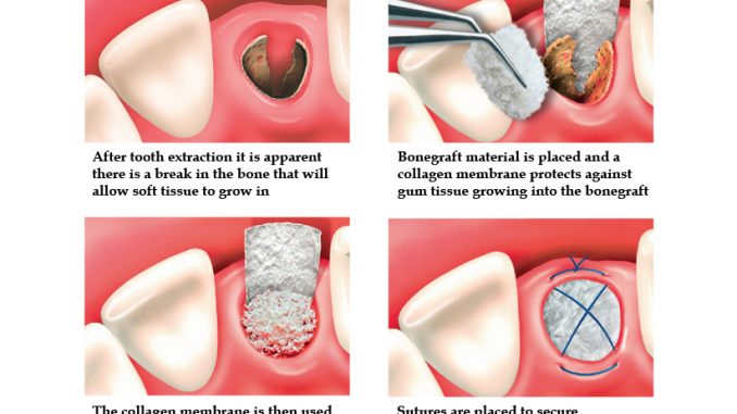 tooth-extraction-and-bone-graft