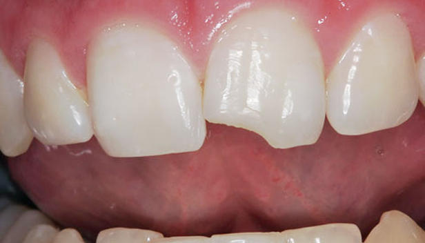tooth repair cost