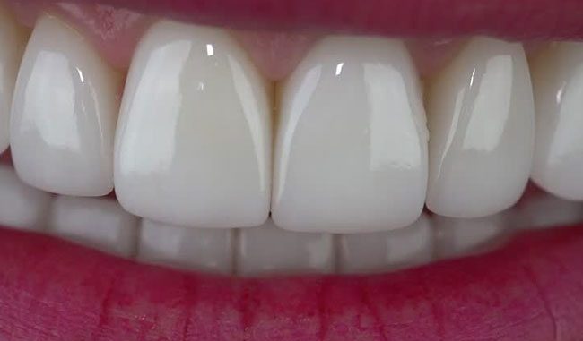 veneer-dentist