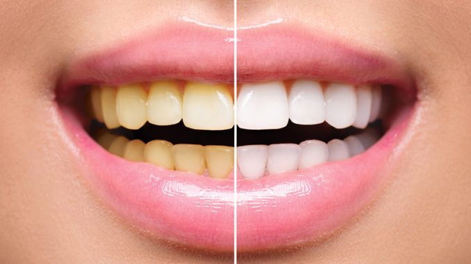 Teeth Braces Whitening After