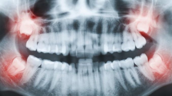 wisdom-teeth-doctor-near-me