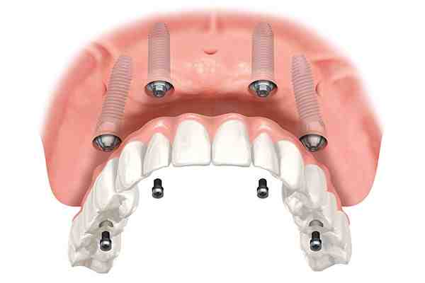Are all on 4 dental implants removable?