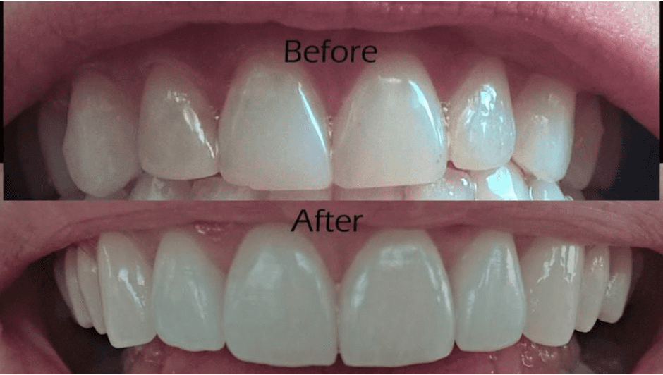 Are dental implants considered cosmetic?