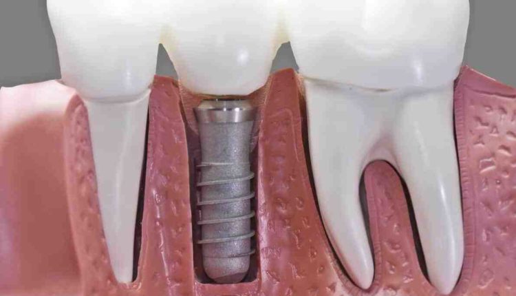 Are dental implants covered by medicaid