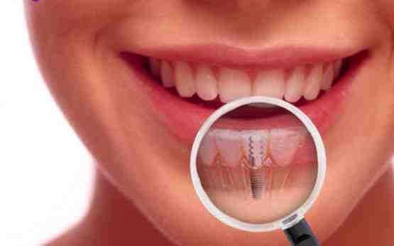 Are dental implants worth it?