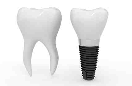 Are mini dental implants permanent?