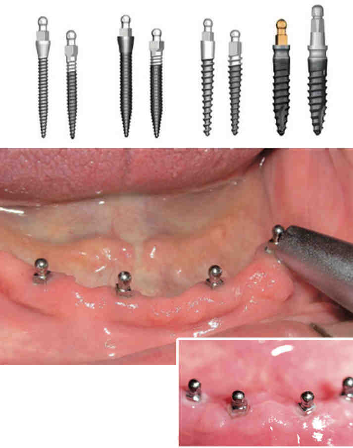What is a mini dental implant Dental News Network