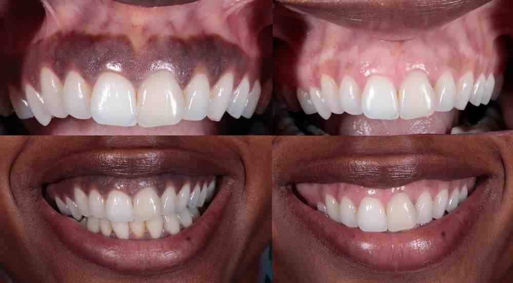 Cosmetic dentistry dark gums Dental News Network