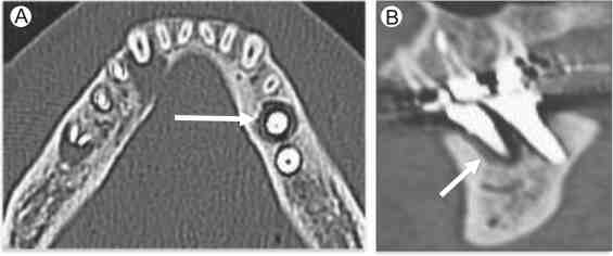 Can I have MRI if I have dental implants?