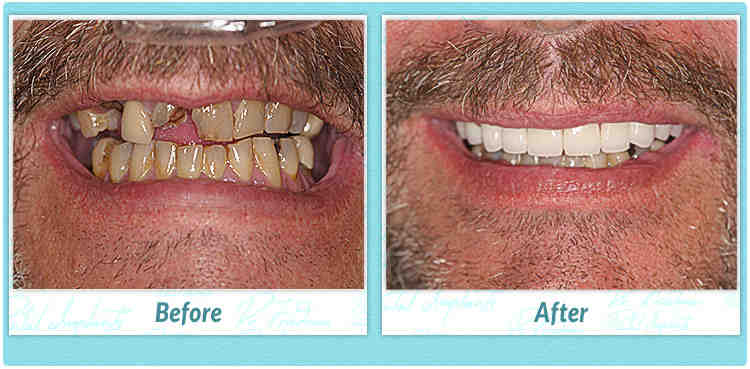 Can a dental implant be done in one day?