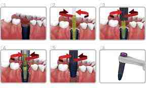 Can a dental implant post be removed?