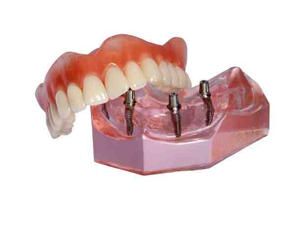 Can dental implants be covered by medical insurance?