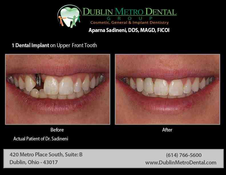 Can you get a dental implant for one tooth?