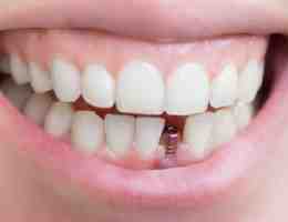 Can you get a dental implant for one tooth?