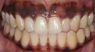 Can you get your gums lightened?