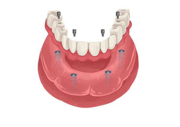 Can you make payments on teeth implants?