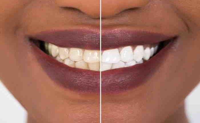 Cosmetic dentistry - dark gums