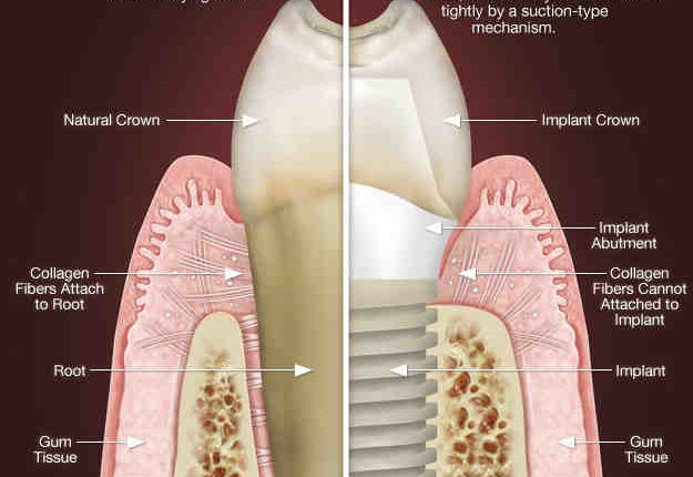 Do dental implants come out