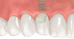 Do dental implants ever need to be replaced?