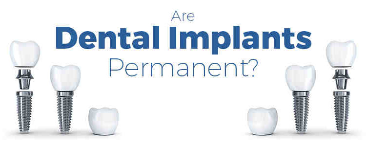 Do dental implants last forever - Dental News Network