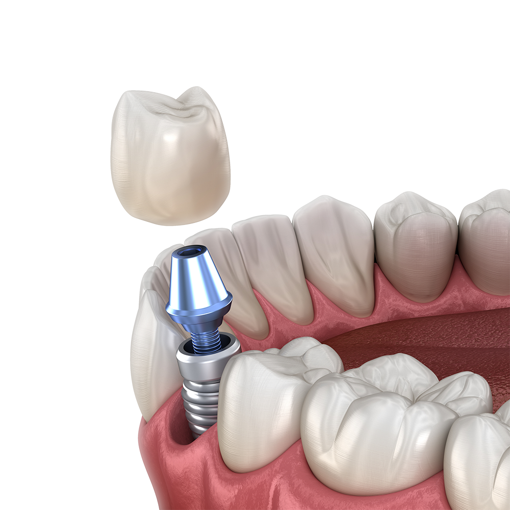 how-to-pay-for-dental-implants-dental-news-network