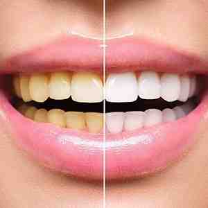 Does Aetna cover Smile direct?