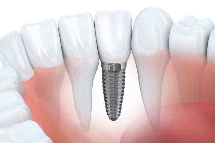 Does aspen dental do implants Dental News Network