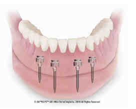 Does Case Western Dental School do implants?