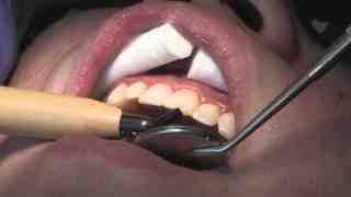 Does MassHealth cover dental implants 2019?