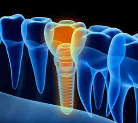Does Medi-cal cover teeth implants?