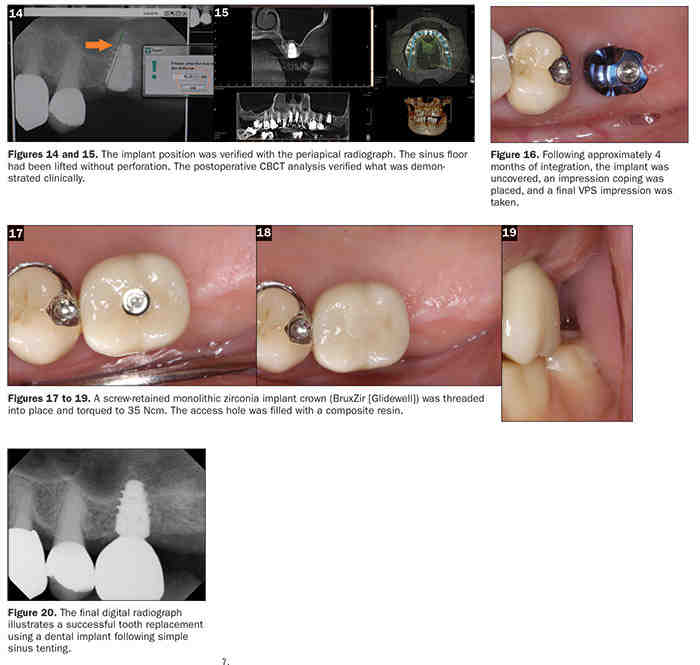 Does paramount advantage cover dental implants - Dental News Network