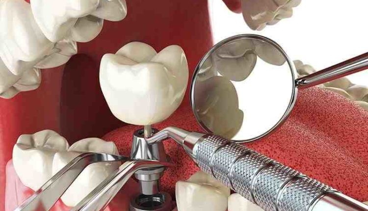 Does caresource cover dental implants