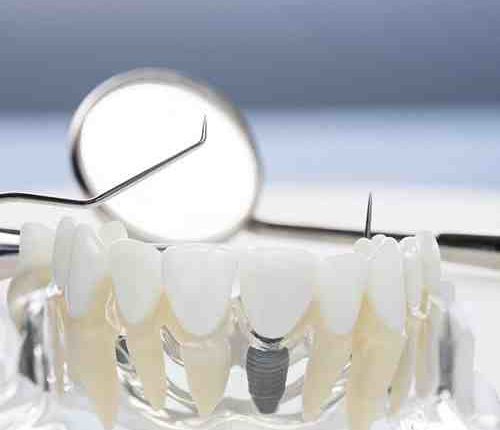 Does Delta Dental Cover Implants » Dental News Network
