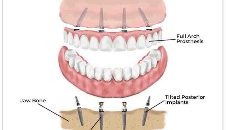 Does medical cover dental implants