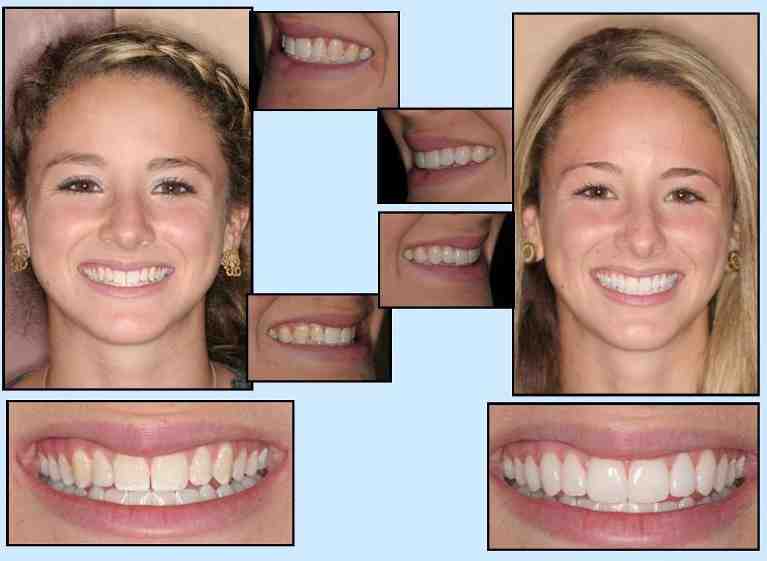 How Much Does a full dental makeover cost?