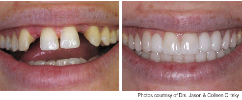How Much Does a full dental makeover cost?