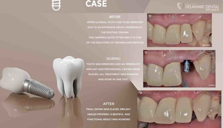 How are dental implants done