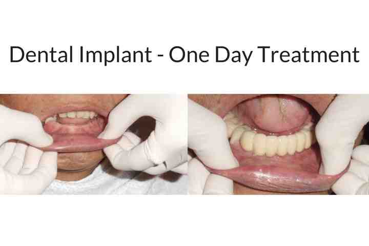 How are teeth implants done in one day?