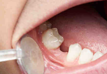 How can I get dental implants covered by insurance?