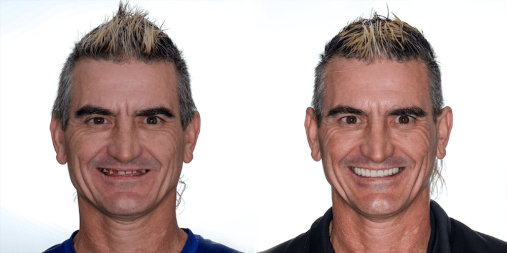 How can I get free dental implants?