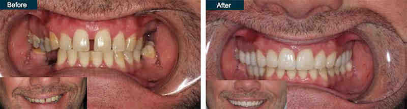 How can I get free dental implants?